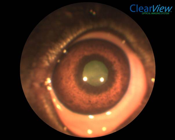 szemészeti glaukóma)